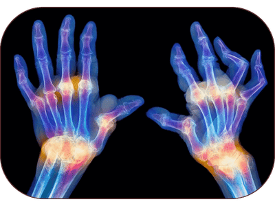 Joint & Arthritis Ayurvedic Treatment in Amritsar