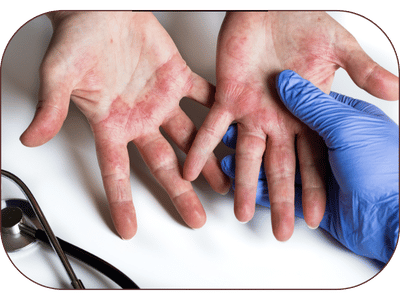 Eczema Ayurvedic Treatment in Amritsar