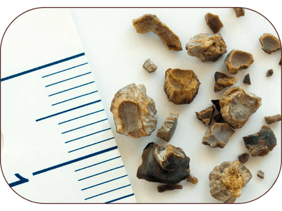 Kidney Stones Ayurvedic Treatment in Amritsar