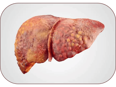 Liver Disorders Ayurvedic Treatment in Amritsar